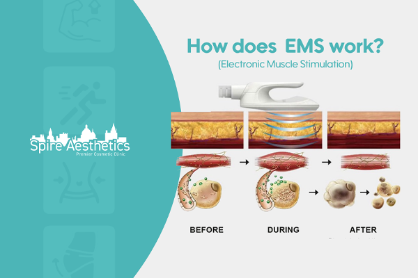 EMS treatment for post pregnancy weight loss treatment East Malling