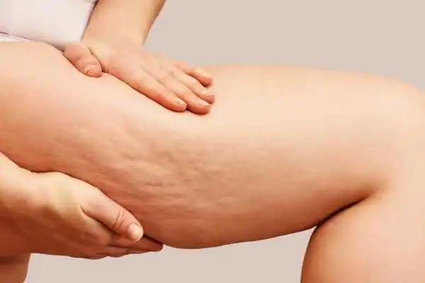 Image of woman showing leg with cellulite East Malling