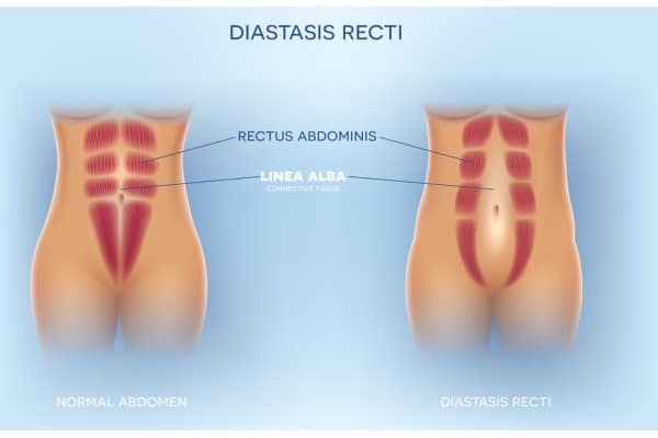 What Non-Surgical Options Are Available for Diastasis Recti East Malling?