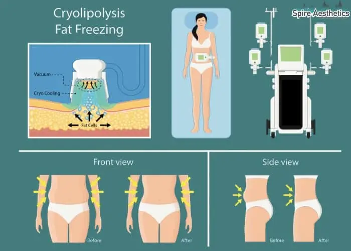 Fat freezing treatment East Malling benefits for competitions to remove stubborn fat deposits.