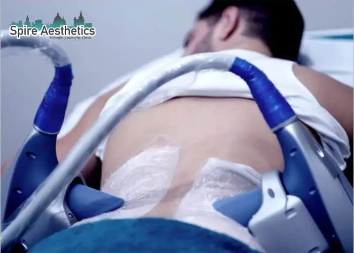 Man having fat freezing treatment done on love handles before a competitions East Malling to create a sculpted look.