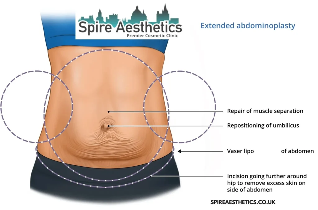 Understanding Loose Skin After Gastric Band East Malling Surgery and HIFU Treatment
