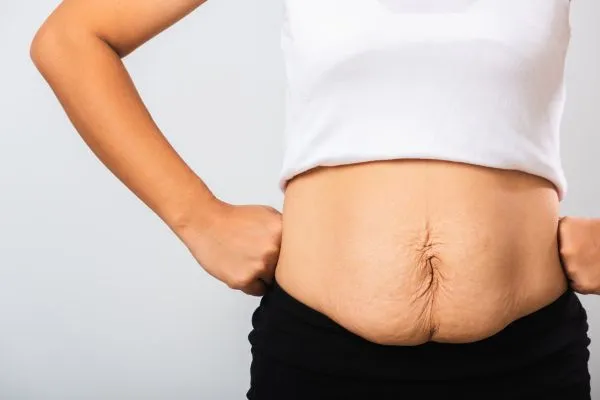 Image of a woman's stomach after weight loss with sagging skin following a gastric band East Malling
