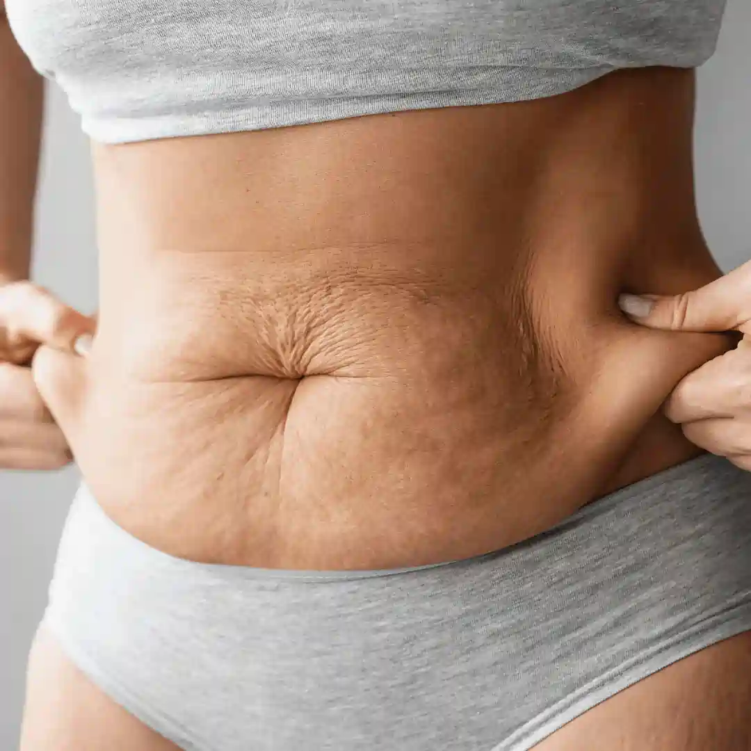 Is It Normal to Have Loose Skin After Pregnancy East Malling?