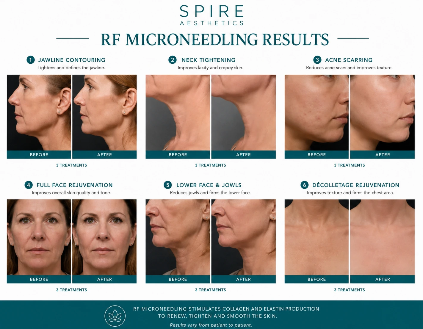 RF Microneedling Skin tightening East Malling results