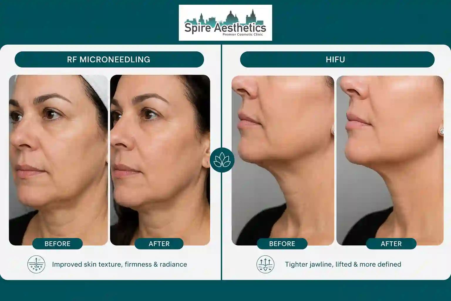 Can RF Microneedling and HIFU Be Combined East Malling?