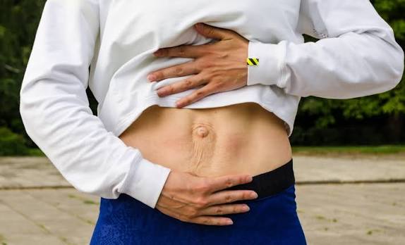 When Could Diastasis Recti Be the Missing Piece of the Puzzle East Malling?