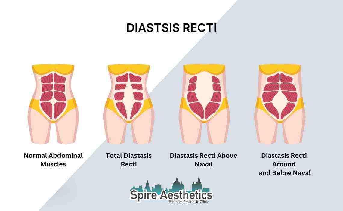 Is Non-Surgical Diastasis Recti Treatment Right for You? Common Concerns Answered East Malling